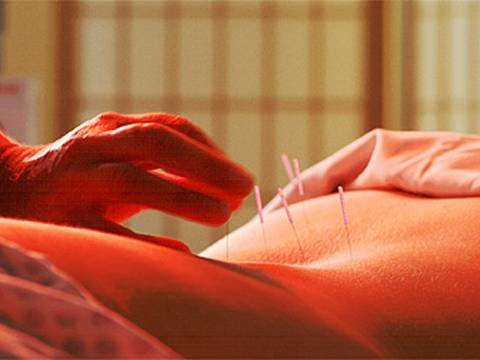 acupuncture 4